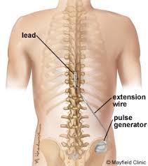 Spinal Cord Stimulator Cost 2024