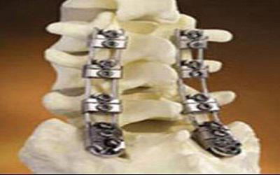 Global Pedicle Screw-Based Dynamic Stabilization Systems Market