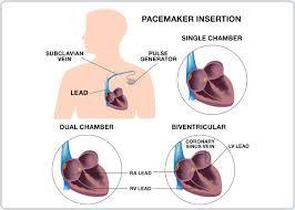 Cardiac Pacing Market