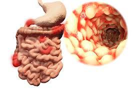 Ulcerative Colitis Market