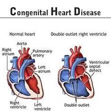 Congenital Heart Defect