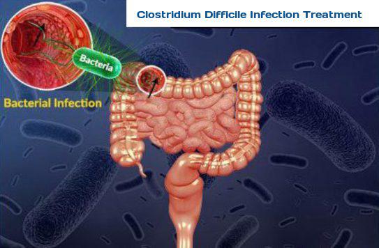 Clostridium Difficile Infection Treatment Market Growth, Size, Trends and Analysis, 2018-2026