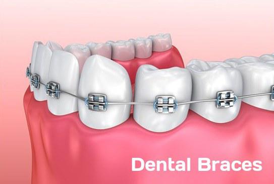 Dental Braces Market - Industry Insights, Size, Share, Growth, Analysis, Trends and Forecasts To 2026