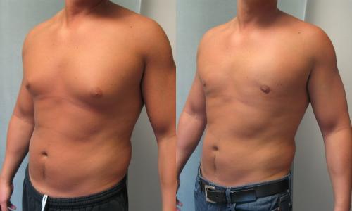 What Are Things We Need To Know Before Considering Vaser Lipo?