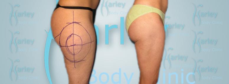 How To Make The Outcome Of A Liposuction Surgery Successful?