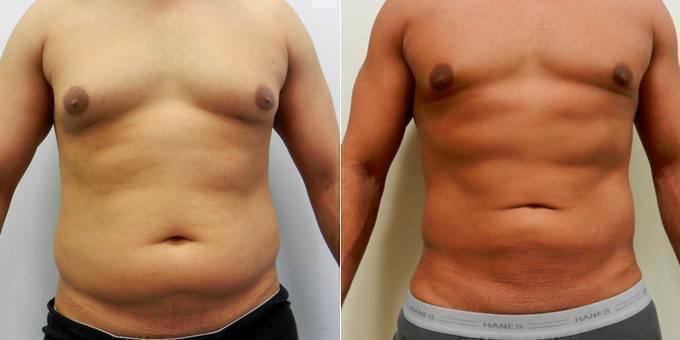 Vaser Liposuction Recovery