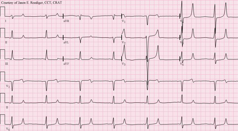 Hyperkalemia Market: Overview, Competitive analysis Market