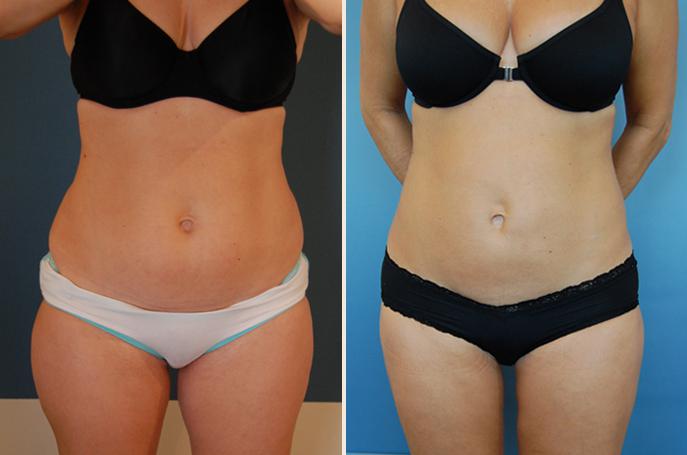 Why Is Vaser Liposuction the Best Choice Today For Fat Reduction?