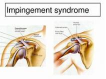 Global Impingement Syndrome Industry Research Report, Growth Trends and Competitive Analysis 2013-2025
