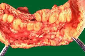 Crohn Disease Market 2018 by its Scientific Reviews, Clinical