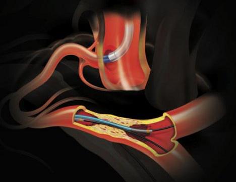 Guidewires Market Size