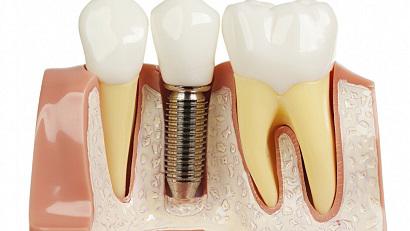 Dental Implants Market, Dental Implants Market Study, Dental Implants Market Size, Dental Implants Market Segmentation, Dental Imp