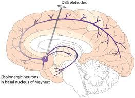 Neurostimulation Market to exceed $16 bn by 2023 by Technology