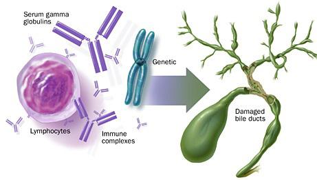 Primary Sclerosing Cholangitis