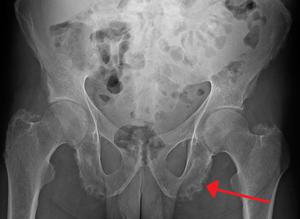 Enthesopathy Treatment Market