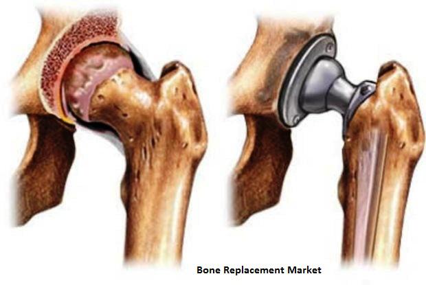 Bone Replacement Market, Bone Replacement Market Player, Bone Replacement Market Region, Bone Replacement Market Type