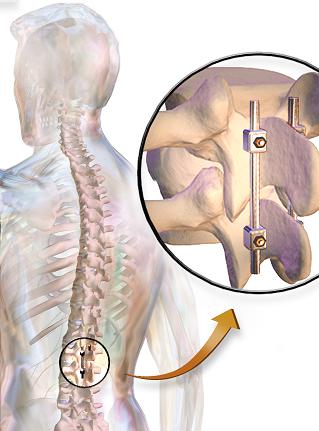 Spinal Fusion Market, Spinal Fusion Market trends, Spinal Fusion Market forecast, Spinal Fusion Market Analysis