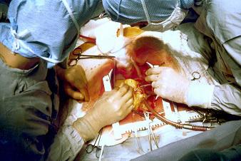 Cryoablation Devices Market, Cryoablation Devices Market trends, Cryoablation Devices Market forecast