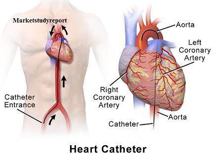 Cardiac Ablation Catheters Market, Cardiac Ablation Catheters Market Trends, Cardiac Ablation Catheters Market Growth, Cardiac Abl
