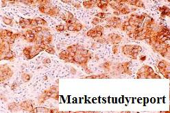 Breast Cancer Monoclonal Antibodies Market, Breast Cancer Monoclonal Antibodies Market Trends, Breast Cancer Monoclonal Antibodies