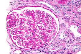 Membranous Nephropathy Market