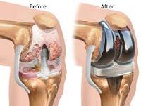 Artificial Joint market , Artificial Joint, Artificial Joint Sales, Artificial Joint Market Share, Artificial Joint Market Size