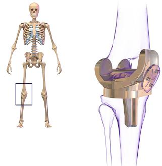 Total Knee Replacement Market, Global Total Knee Replacement Market Size, Total Knee Replacement Industry