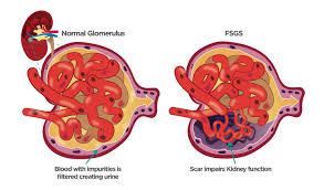 Focal Segmental Glomerulosclerosis (FSGS) Market