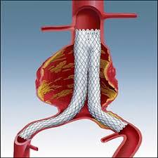 Stent Grafts Market