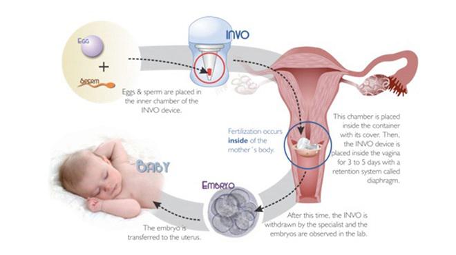 In-vitro fertilization (IVF) Market Types of cycle, Thawed IVF, Application, Size Analysis and Industry Forecast, 2018-2023.
