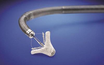 Global Transcatheter Mitral Valve Repair and Replacement Market