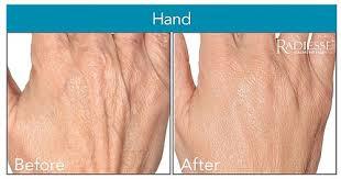 TURN BACK TIME AND IMMEDIATELY RESTORE VOLUME TO AGING HANDS