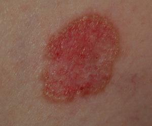 Global Basal Cell Carcinoma Treatment Market
