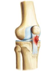 Patellar Tendinitis Market