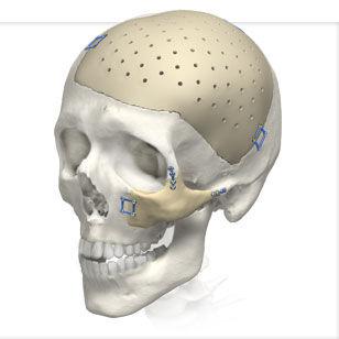 Latest Report On Cranial Implant Market 2019-2025 | Estimated By Top Key Players Biomet, Stryker, Tecomet