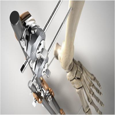 Global External Fixation Systems Market Report 2019 Companies included Depuy Synthes (J&J), Stryker, Orthofix, Smith & Nephew, Wright Medical, Zimmer Biomet, Lima Corporate and Others