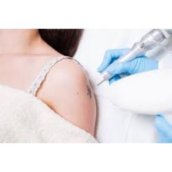 Global Tattoo Removal Service Market 2019