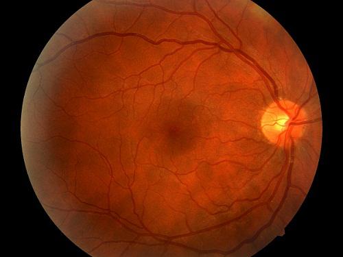 Diabetic Retinopathy Market