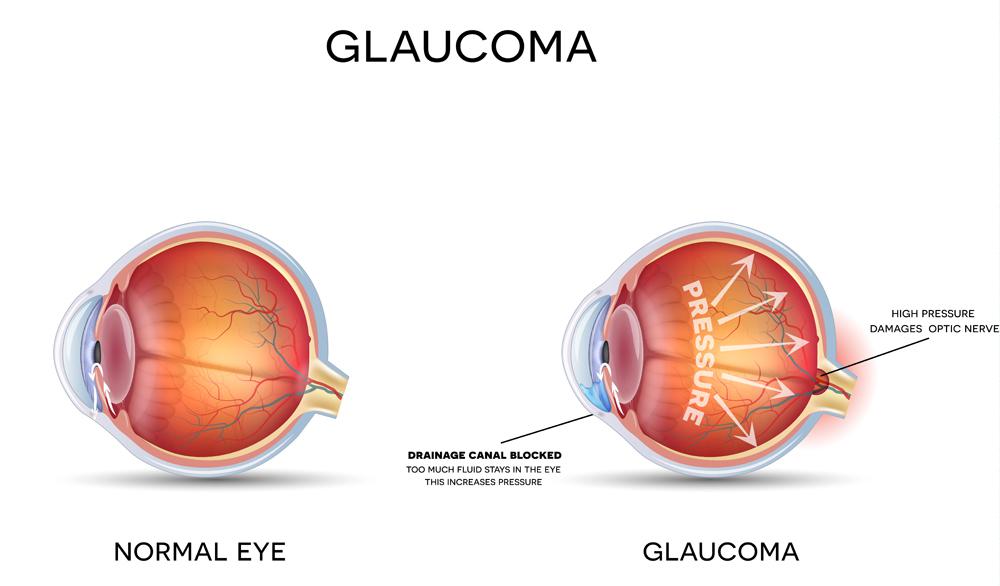 Global Glaucoma Treatment Market Professional Survey