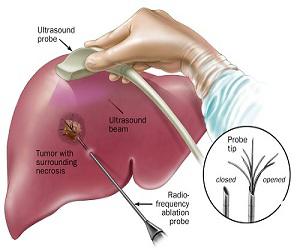 Global Tumor Ablation Market