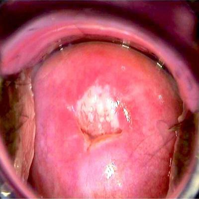 Global Colposcopy Market Report 2019 Companies included Leisegang, Welch Allyn, Philips, Olympus, Zeiss, Centrel, OPTOMIC, MedGynand Others