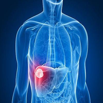 Global Tumor Ablation Market Report 2019 Companies included Angiodynamics, Medtronic, Boston Scientific, Galil Medical, Neuwave Medicaland Others