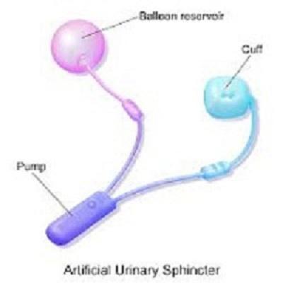 Artificial Urinary Sphincter Market Comprehensive Report 2017