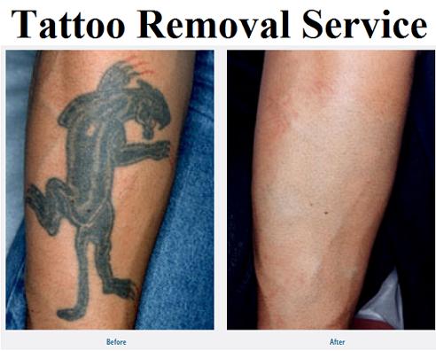 How it works - Madison Laser Tattoo Removal