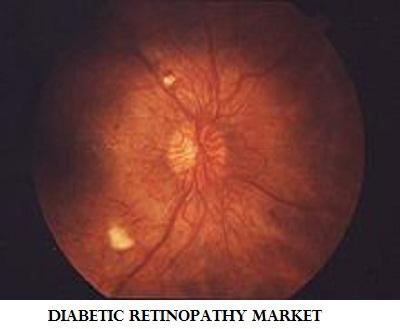 Diabetic-Retinopathy-Market