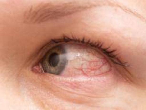 Allergic Conjunctivitis