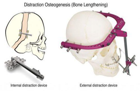 Distraction Osteogenesis Devices