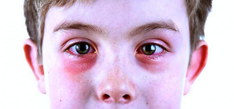 Global Allergic Conjunctivitis Market Research Report