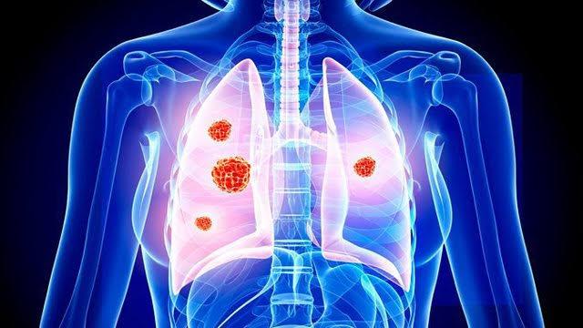 Lung Cancer Therapeutics