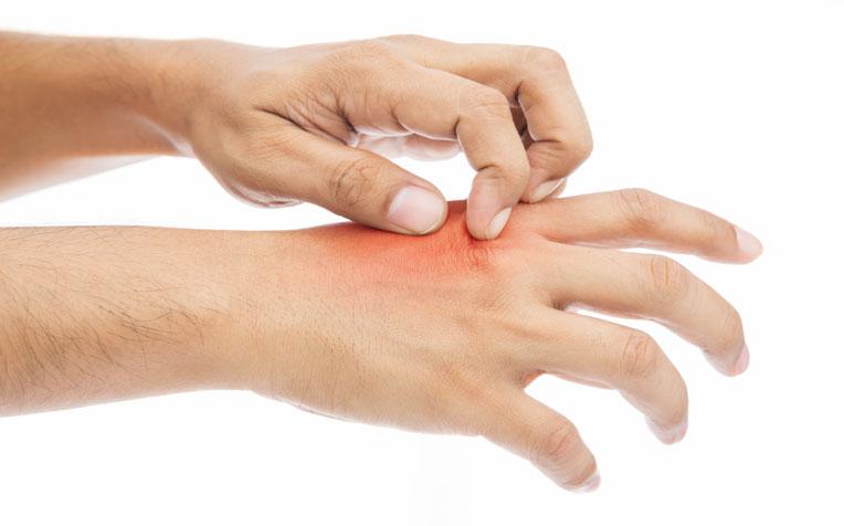 Global Burns Treatment Market Forecast From 2014-2025 by Top Key Players Adocia, AlgiPharma, AS Amarantus Bioscience Holdings, Inc